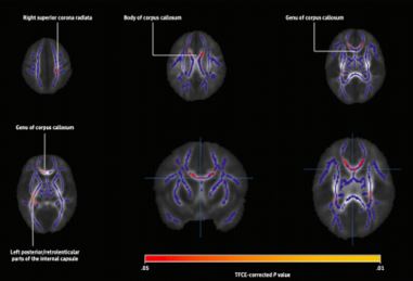 Alterações cerebrais dos filhos recém-nascidos